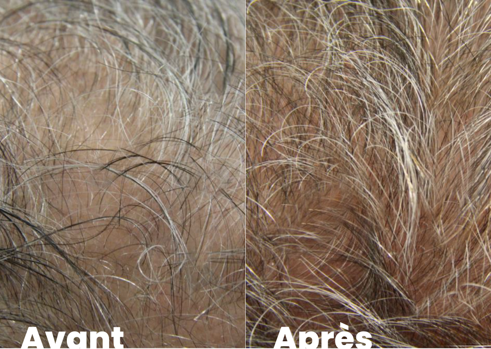 Photos avant-après d'un patient de calvitie masculine
