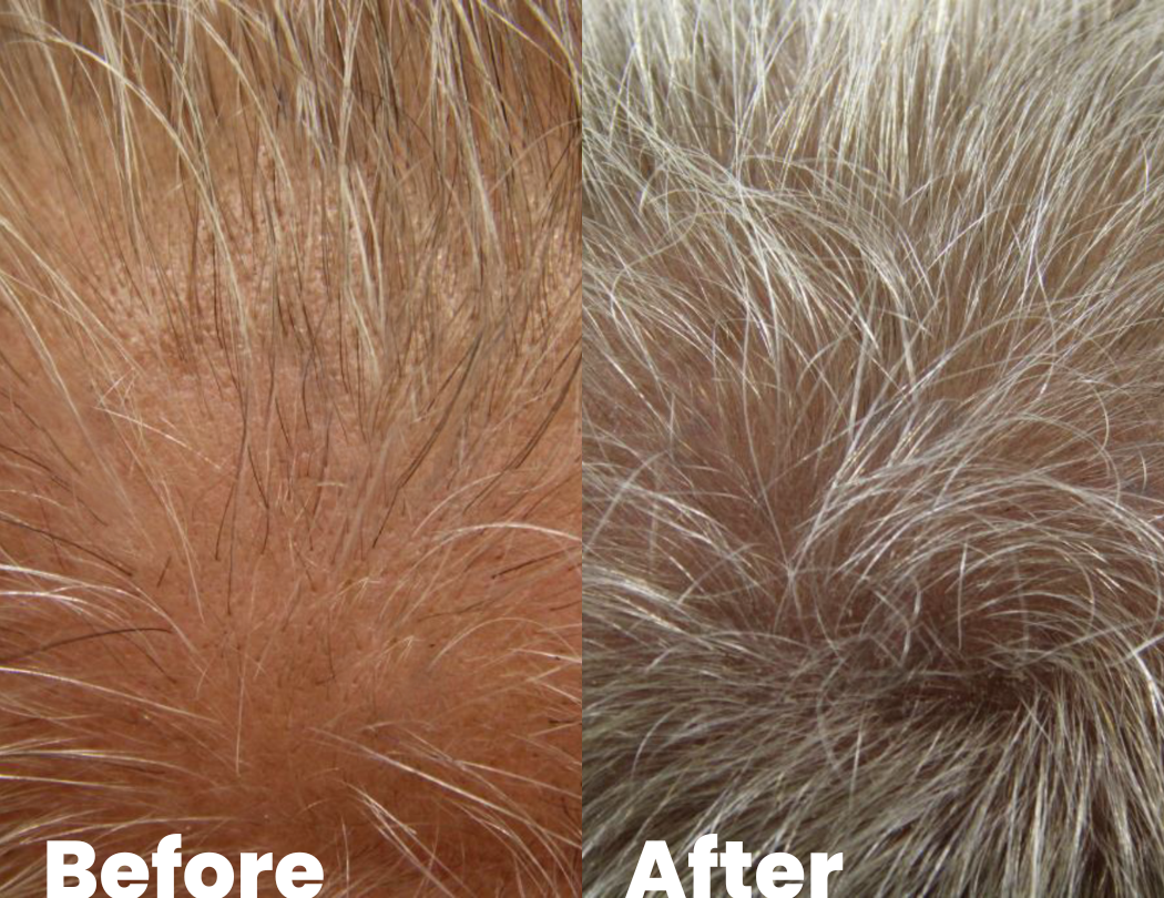 thinning hair before and after pictures