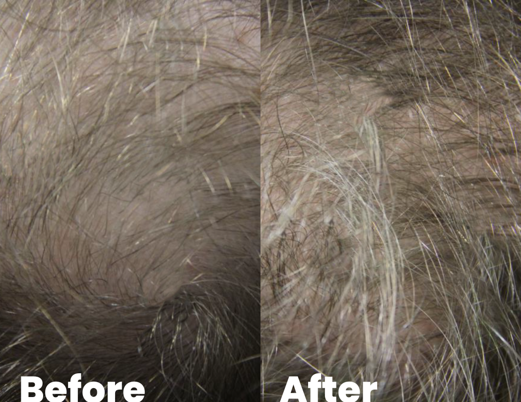 Results after 6 months of alopecia treatments