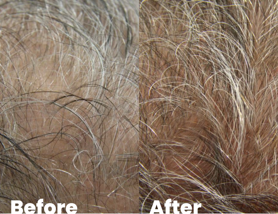 Results after seeing a hair loss specialist
