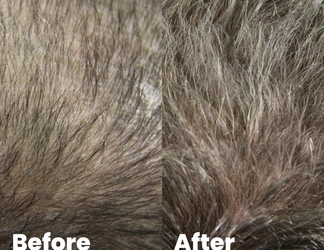 Male pattern baldness before and after pictures