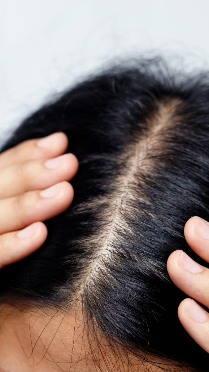 If you have androgenic alopecia, Hair Loss Rx Consult can help